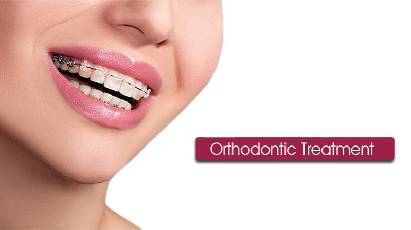 Orthodontic Treatment Options for Children and Adults