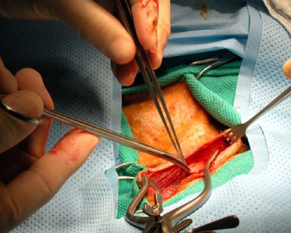 PAD Vascular Surgery